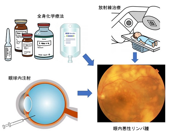 図2-3　眼内悪性リンパ腫の治療